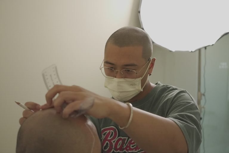 Truedots : Scalp Micropigmentation(SMP) Artist in Toronto (hairline, hair loss clinic)