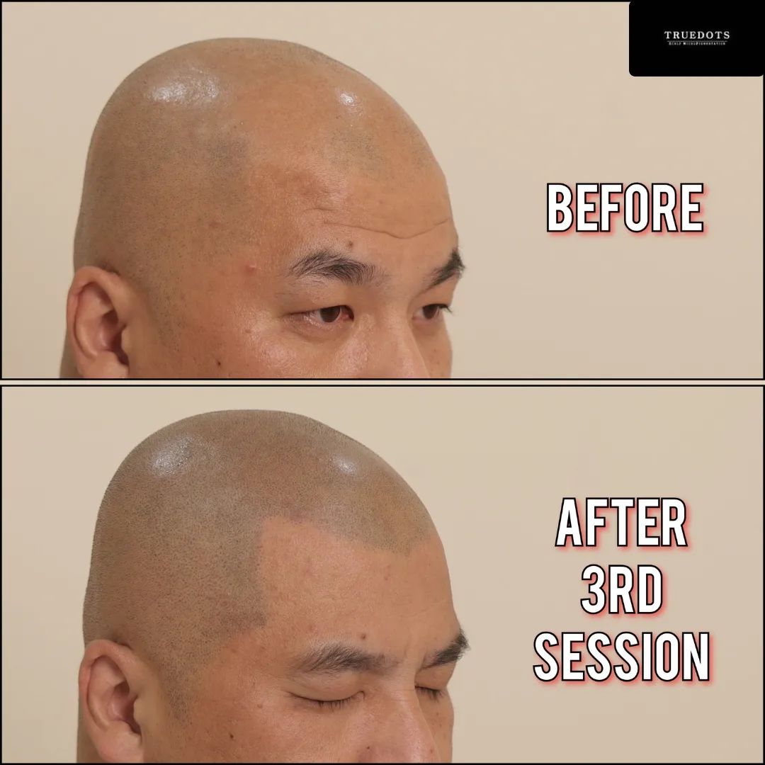 Truedots : Scalp Micropigmentation(SMP) in Toronto (hairline, hair loss clinic)