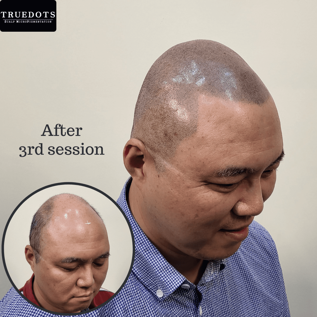 Truedots : Scalp Micropigmentation(SMP) in Toronto (hairline, hair loss clinic)