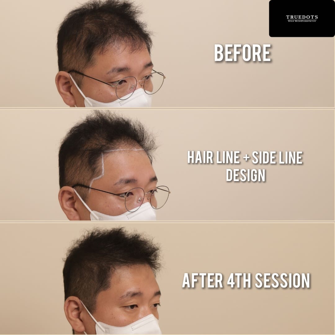 Truedots : Scalp Micropigmentation(SMP) in Toronto (hairline, hair loss clinic)