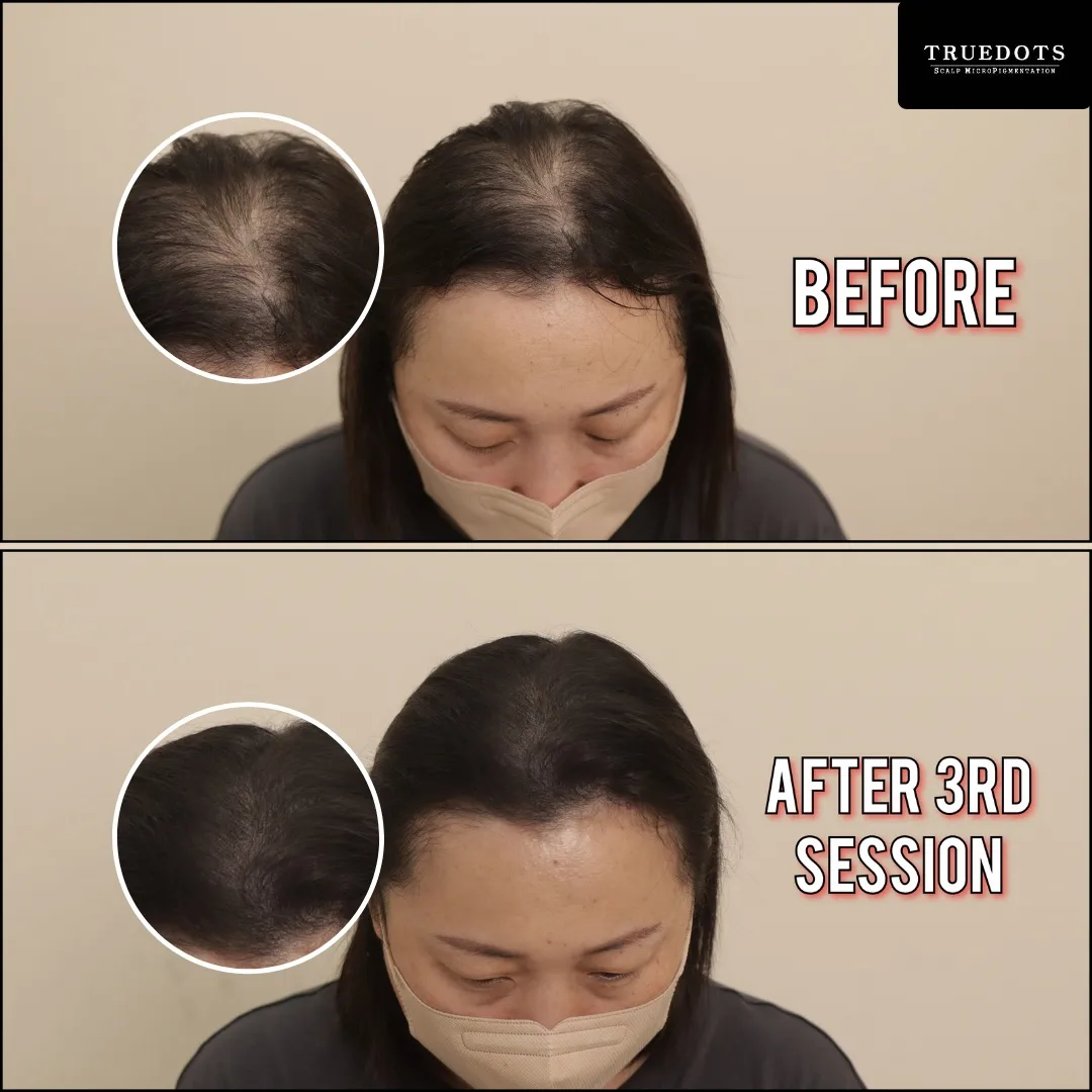 Truedots : Scalp Micropigmentation(SMP) in Toronto (hairline, hair loss clinic)