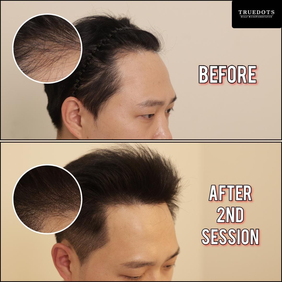 Truedots : Scalp Micropigmentation(SMP) in Toronto (hairline, hair loss clinic)