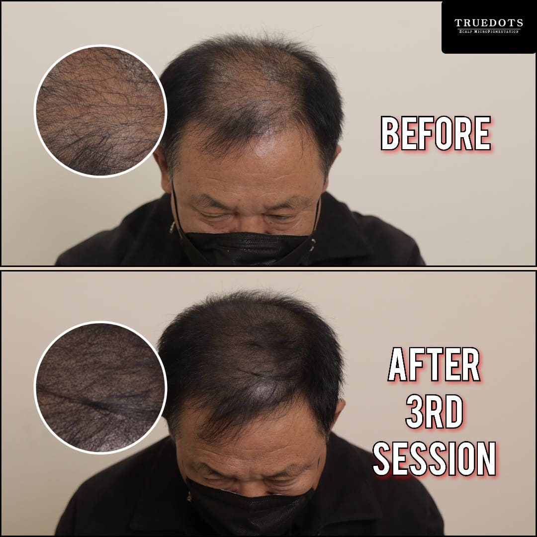 Truedots : Scalp Micropigmentation(SMP) in Toronto (hairline, hair loss clinic)