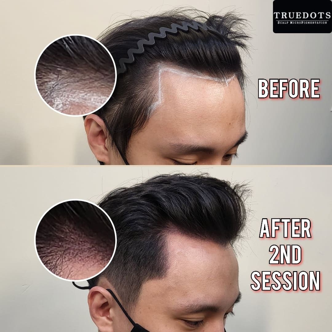 Truedots : Scalp Micropigmentation(SMP) in Toronto (hairline, hair loss clinic)