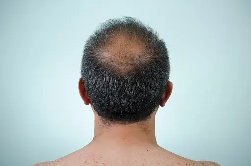 Truedots : Scalp Micropigmentation(SMP) Artist in Toronto (hairline, hair loss clinic)