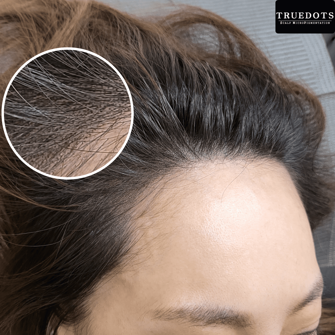 Truedots : Scalp Micropigmentation(SMP) in Toronto (hairline, hair loss clinic)